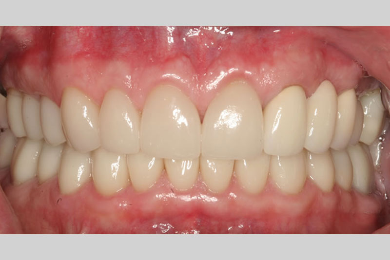 crowns case1 after