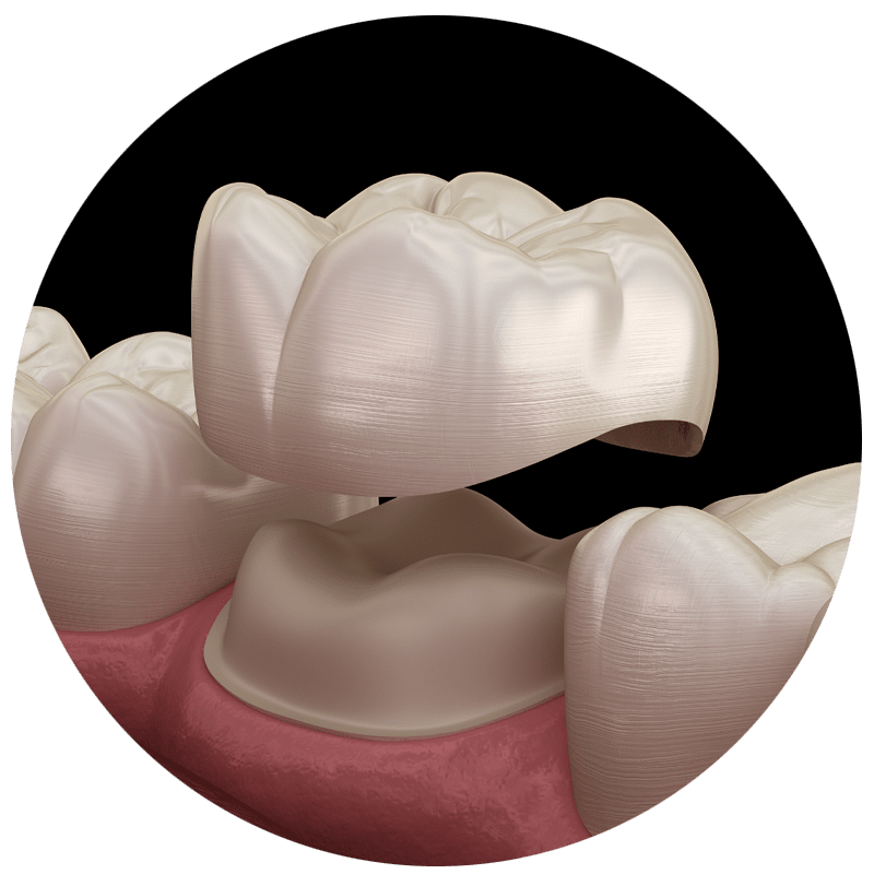 dental crowns model