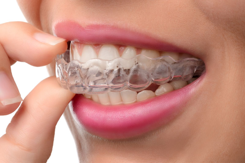 dental patient wearing mouth guard