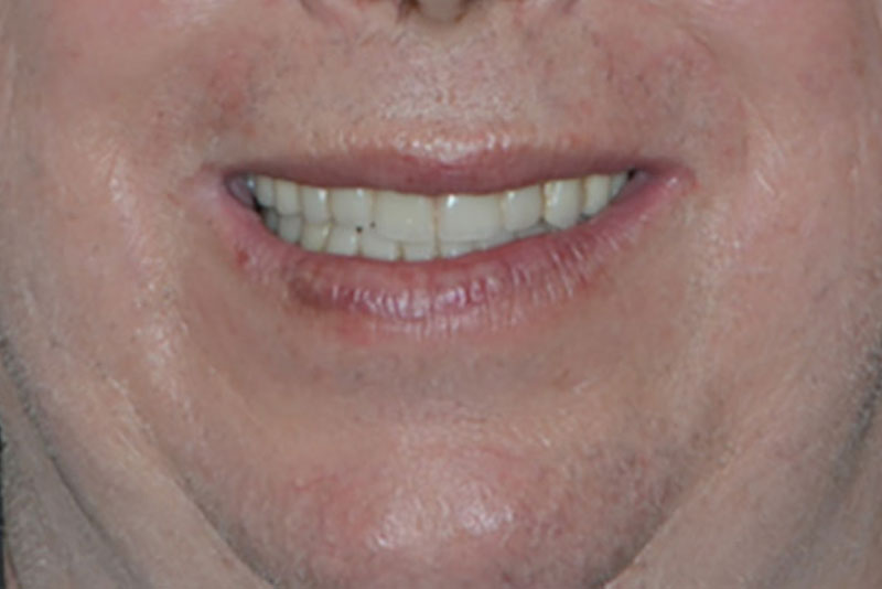 dentures case1 after