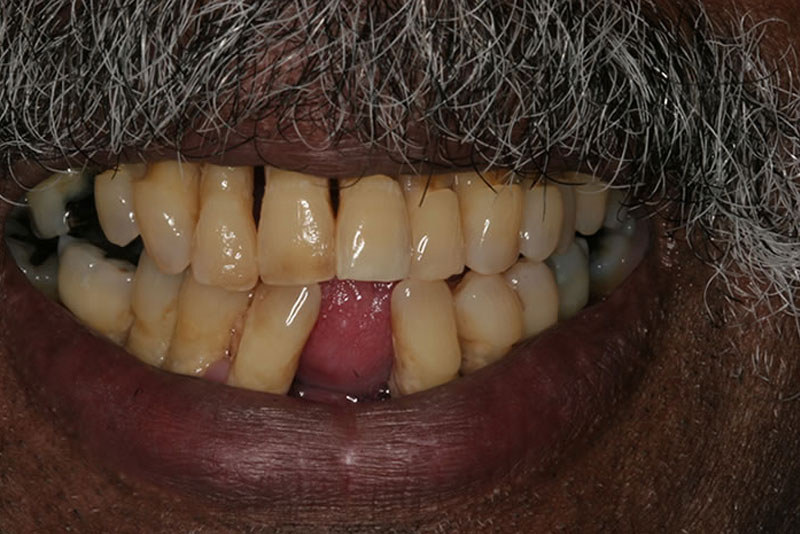 dentures case4 after