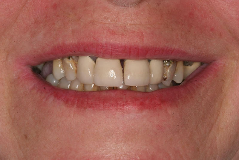 dentures case5 before