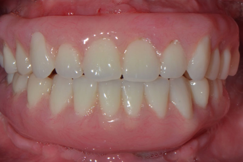 fixed hybrid dentures case1 after