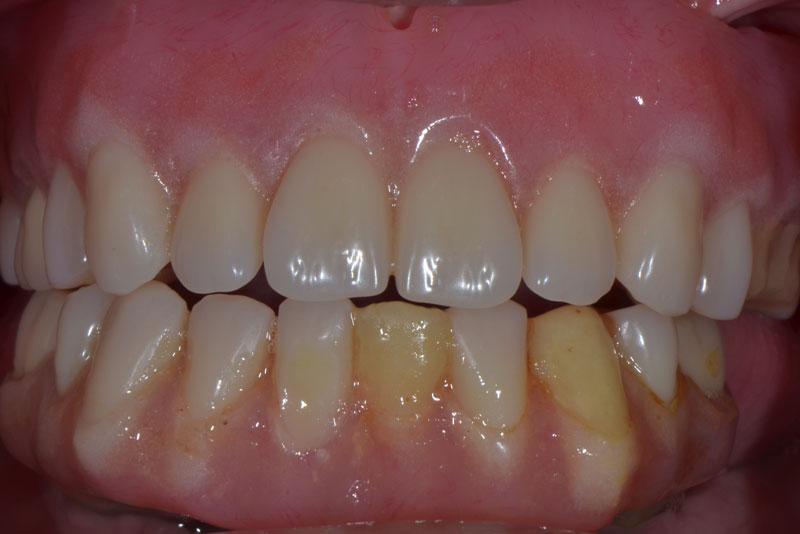 fixed hybrid dentures case1 before