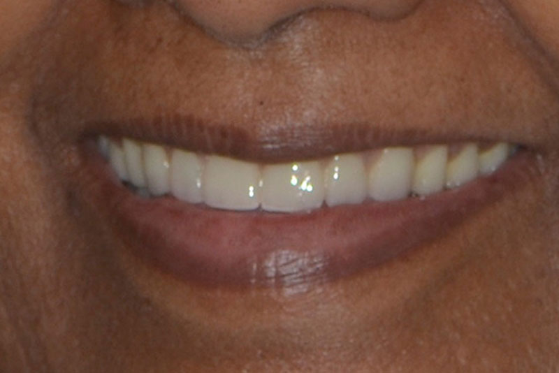 full mouth reconstruction case 4 after