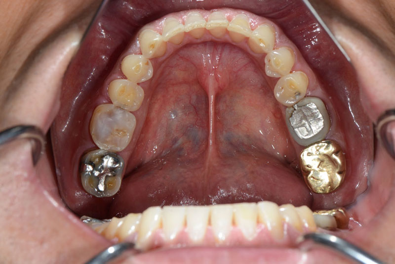 full mouth rehabilitation case1 before