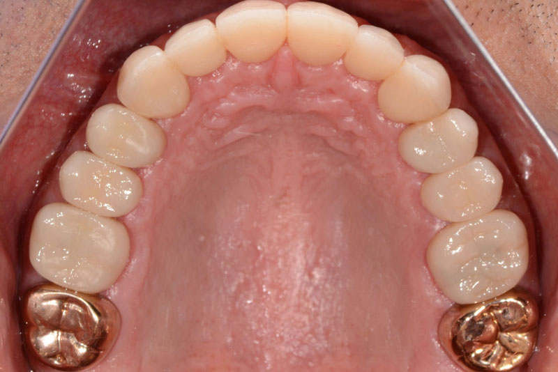 full mouth rehabilitation case2 after