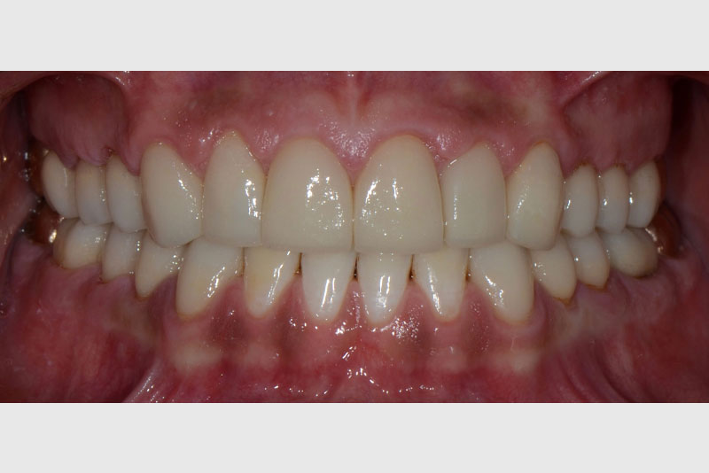 full mouth rehabilitation case3 after