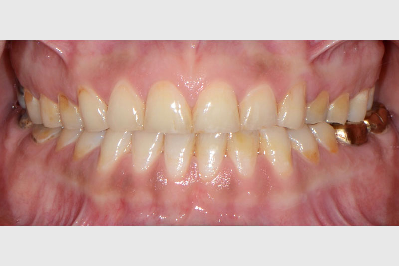 full mouth rehabilitation case3 before