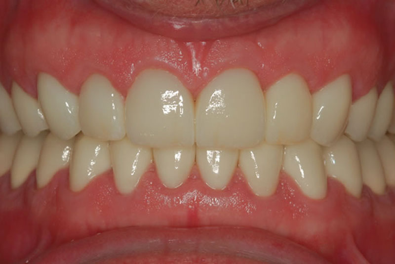 multiple crowns case2 after