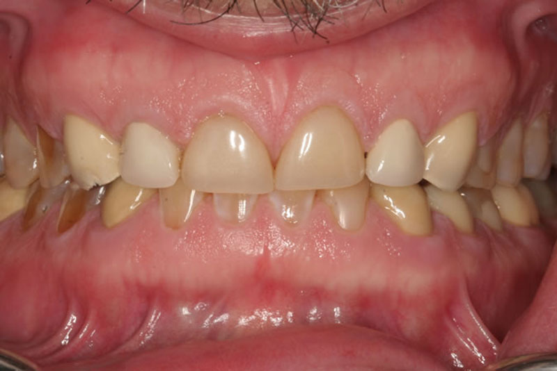 multiple crowns case2 before
