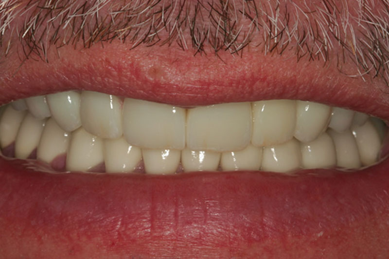 multiple crowns case3 after