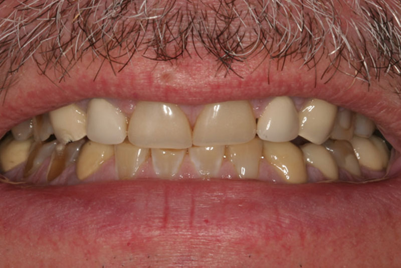 multiple crowns case3 before