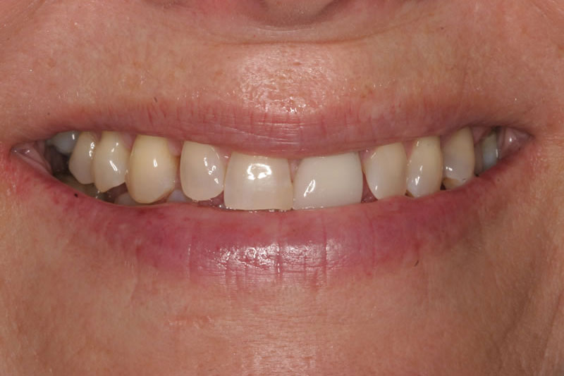multiple crowns case4 before