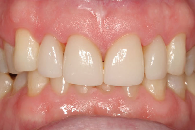 multiple crowns case6 before