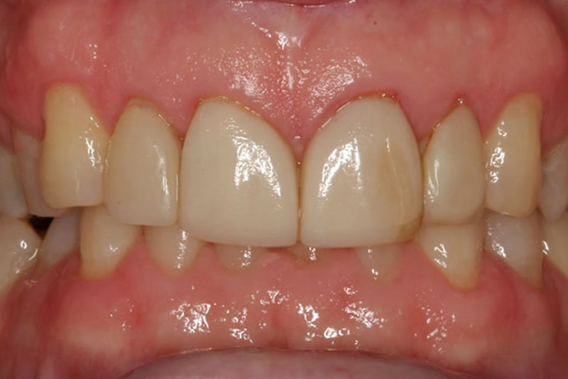 multiple crowns case6 before