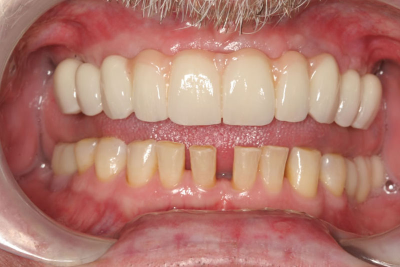 permanent dental bridge case2 after