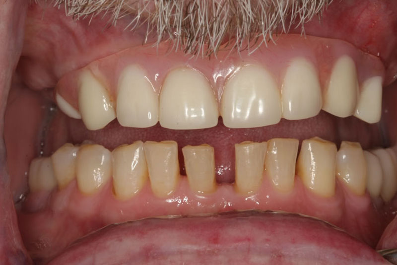 permanent dental bridge case2 before