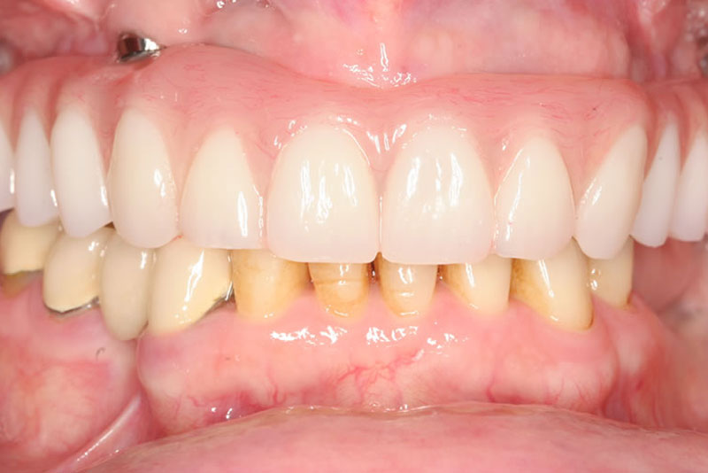 permanent dental bridge case3 after