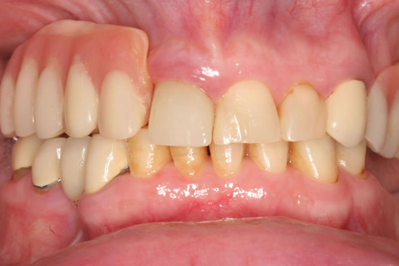 permanent dental bridge case3 before