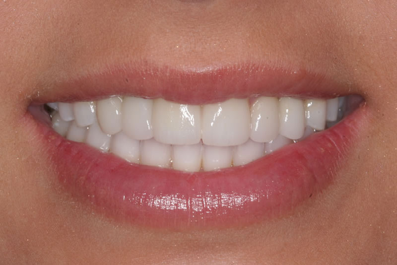 reconstructive dentistry case1 after