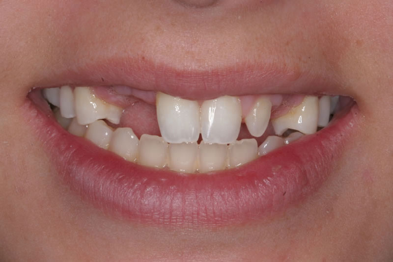 reconstructive dentistry case1 before