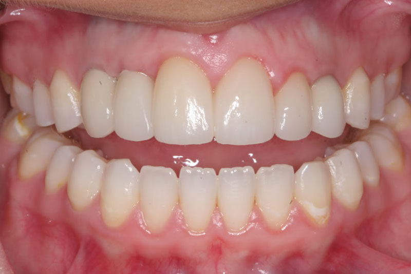 reconstructive dentistry case2 after
