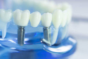 Dental Implant in a Model