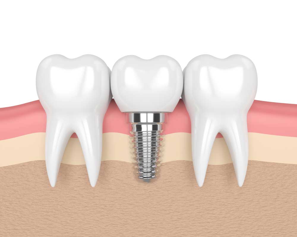 a diagram of a placed dental implant