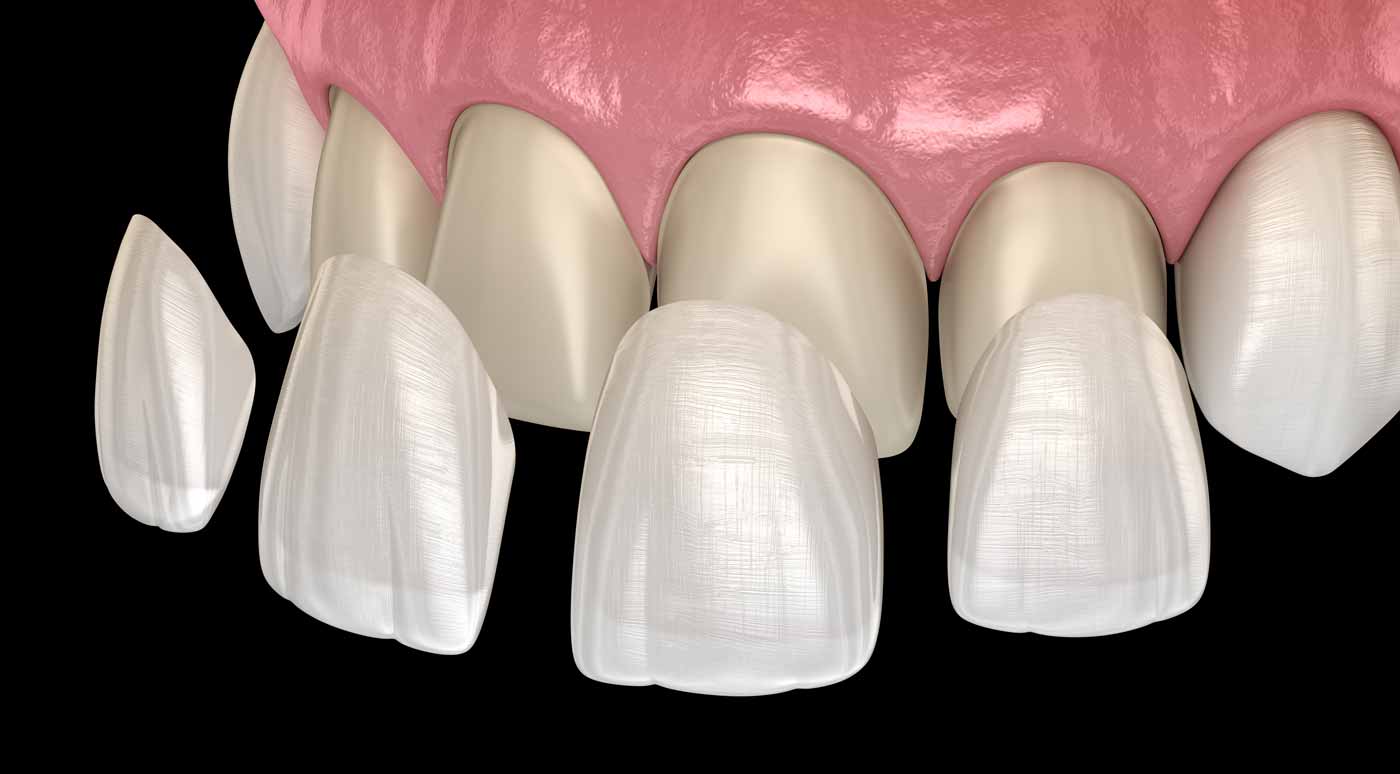 a diagram of porcelain veneers being placed on teeth