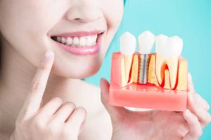 a dental patient holding up a model of a placed dental implant