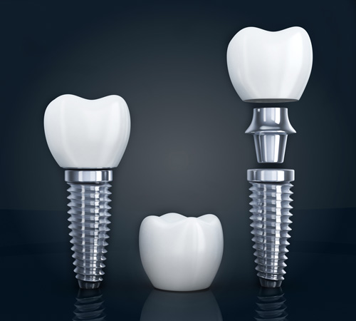 the three different parts of a placed dental implant