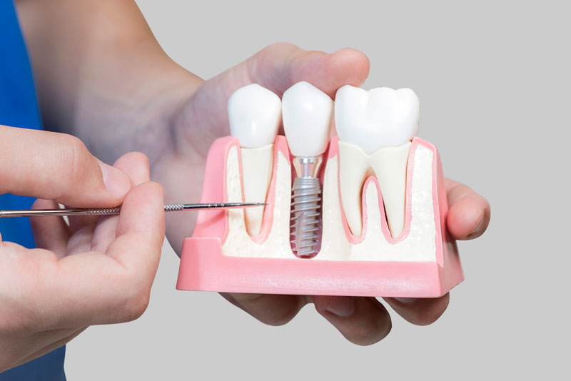 Dental Assistant Showing Off A Dental Implant In A Jawbone Cutaway Model in Jacksonville, FL