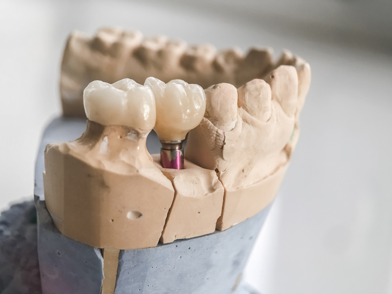 Image of a prosthesis jaw with a implant.