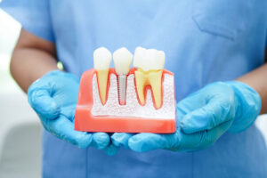 Doctor hold dental implant, artificial tooth roots into jaw, root canal of dental treatment, gum disease, teeth model for dentist studying about dentistry
