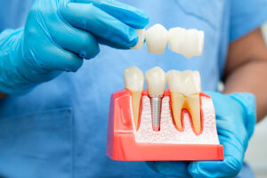 A dental professional wearing blue gloves holds a model showing a dental implant in the jawbone, demonstrating how a bridge fits over the implant and natural teeth.