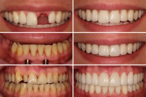 Collage of before-and-after photos showcasing various dental implant cases: single tooth replacement, implant-supported bridges, and full arch restoration. No text on image.