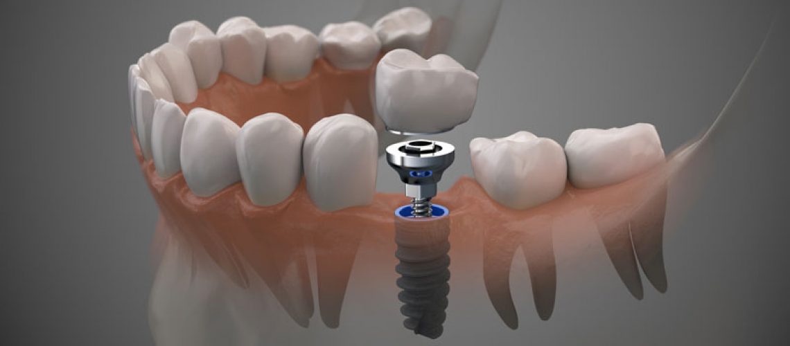 3D rendering of a human dental implant. It shows a lower jaw with a full set of teeth and a metal dental implant post that is placed into the jawbone.