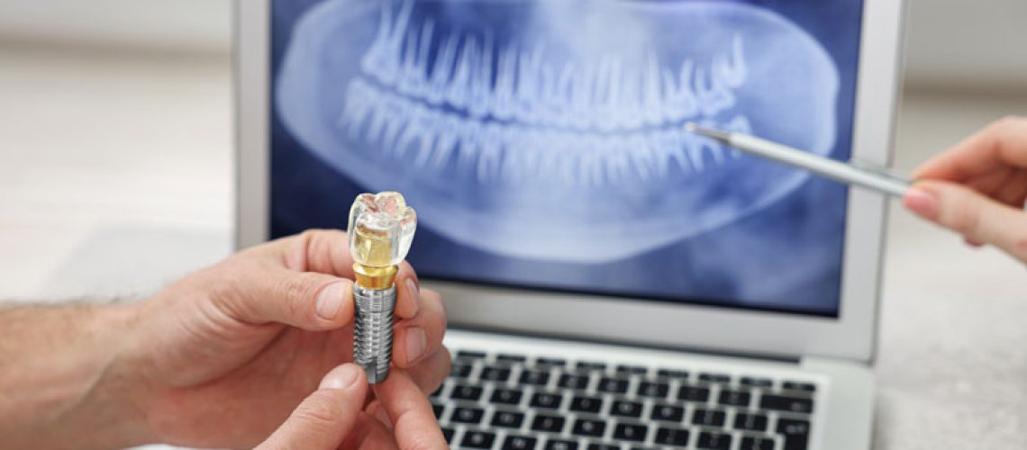 A dental professional holds a dental implant model while pointing at a dental X-ray on a laptop screen.