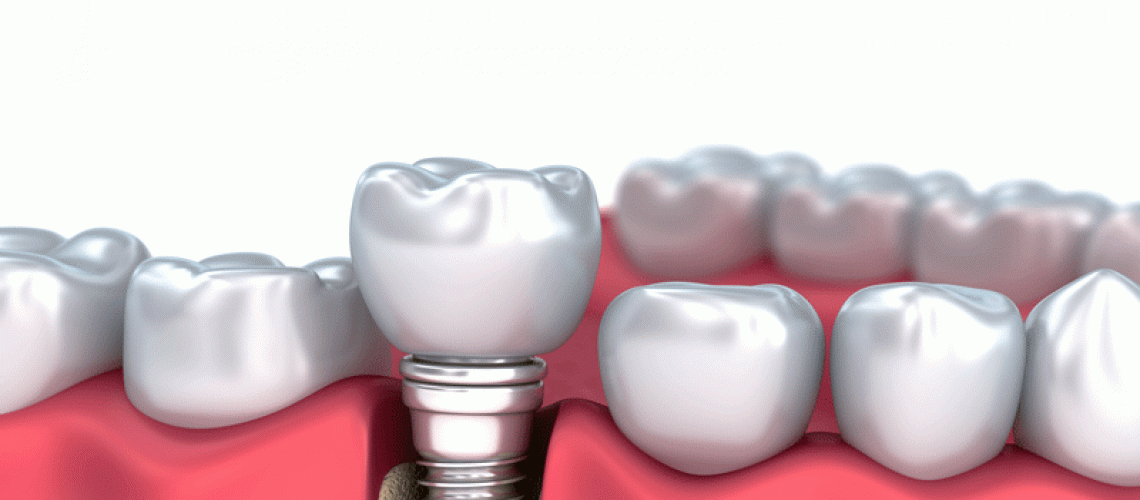 Medically accurate 3D illustration of a Dental Implant.