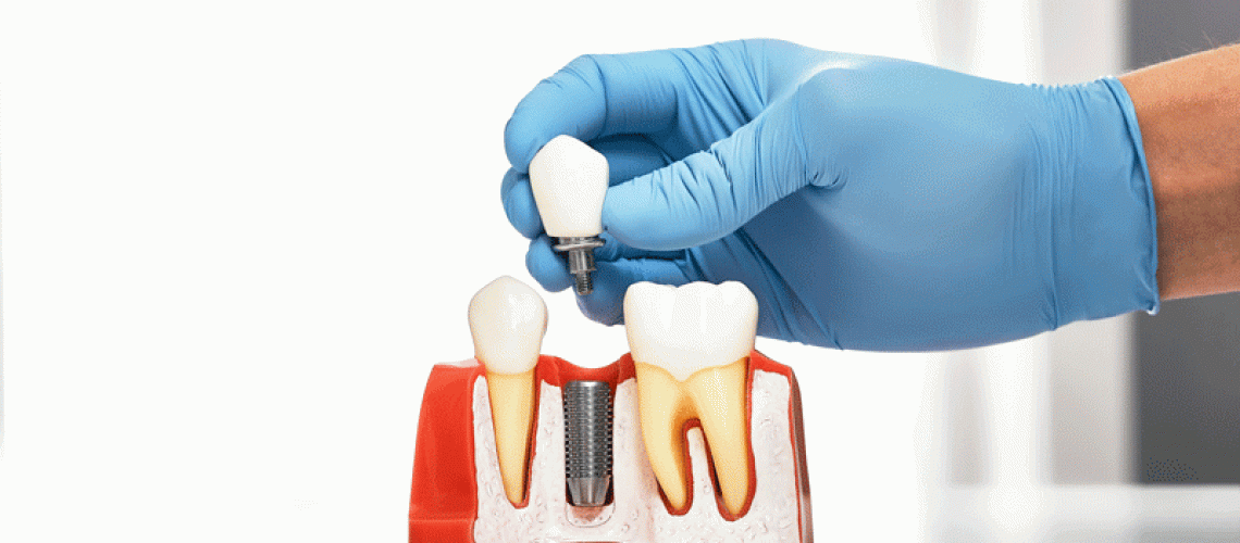 Dentist showing the installation of a dental implant on the anatomical model of teeth.