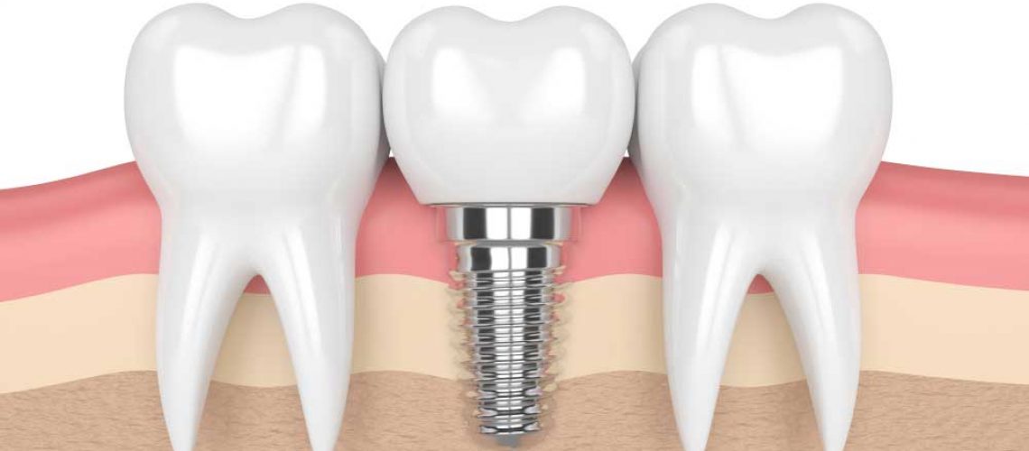 a diagram of a placed dental implant