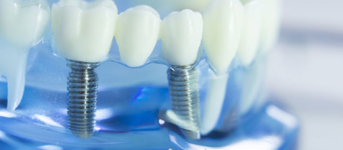 Dental Implant in a Model