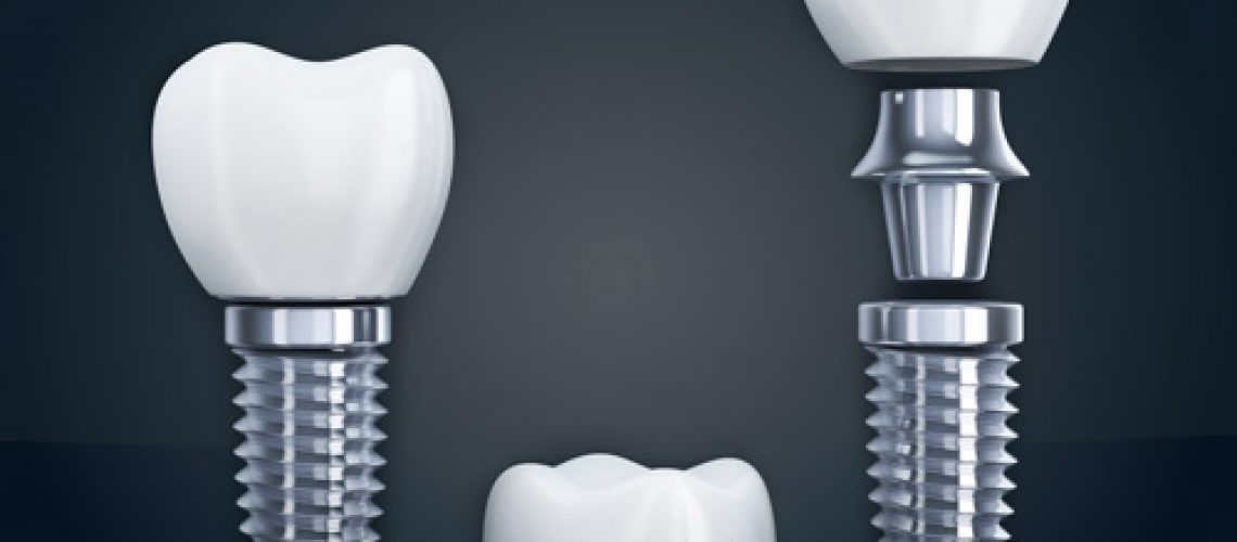 the three different parts of a placed dental implant