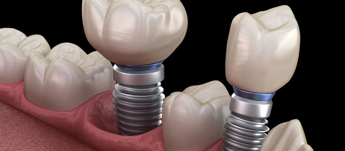 An image of a model of multiple dental implants.