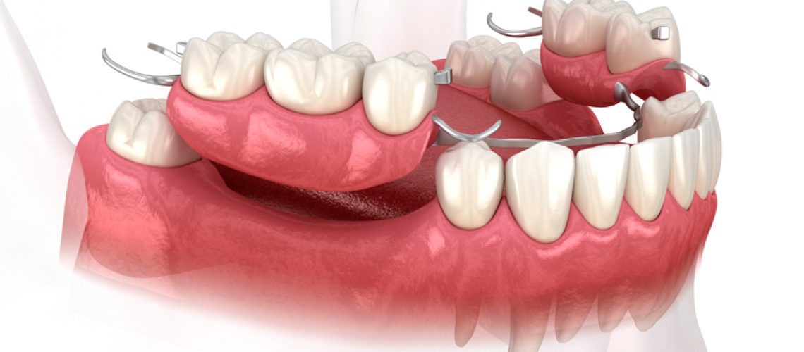Close-up 3d image of a dental implant bridge on both sides of the bottom teeth