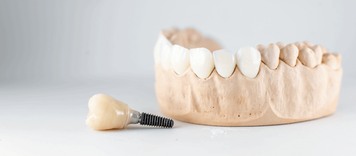 Dental implant in front of lower mouth model.