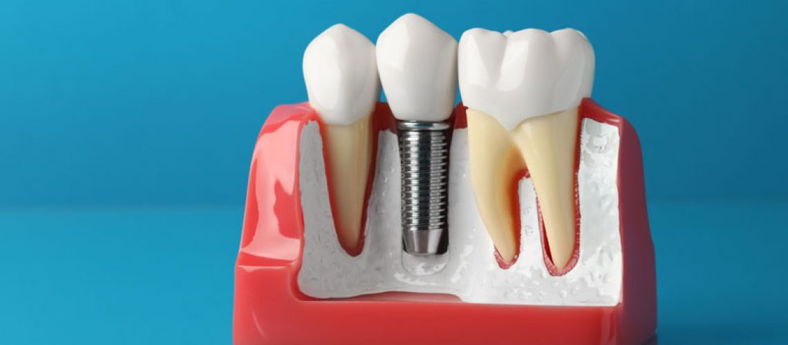 blue background; a dental implant model on reflective glass.