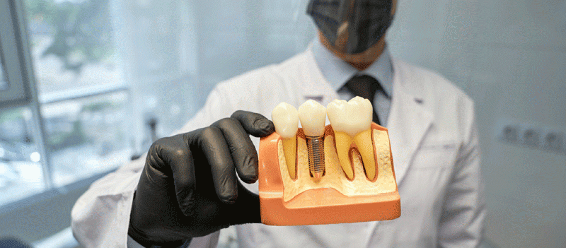 Doctor holding a model of a dental implant.