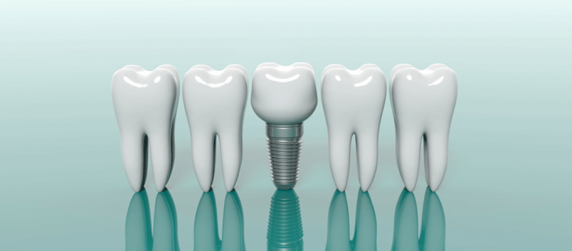 3d model of 4 teeth with a dental implant in the middle of them.